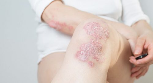 Revolucionan el tratamiento de la psoriasis en Perú 🔍
