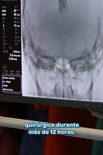 Por primera vez se realizó un bypass cerebral para tratar un aneurisma y fue todo un éxito (video)🙌