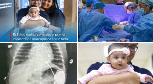 Por primera vez en Latinoamérica médicos peruanos implantan un marcapasos a bebé prematura  👏